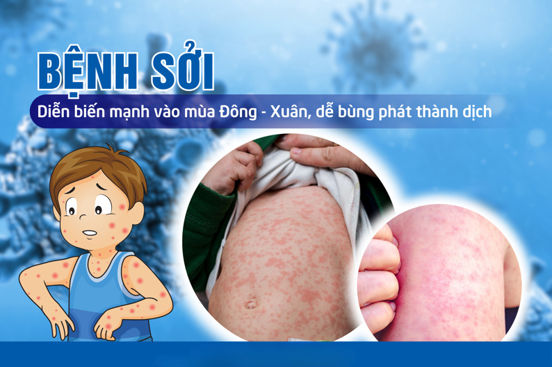 Các quận, huyện tổ chức khoanh vùng, xử lý triệt để khu vực có bệnh nhân, ổ dịch Sởi