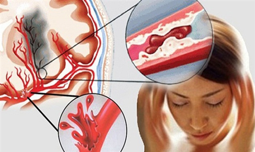 Người trẻ không được chủ quan trước bệnh đột quỵ