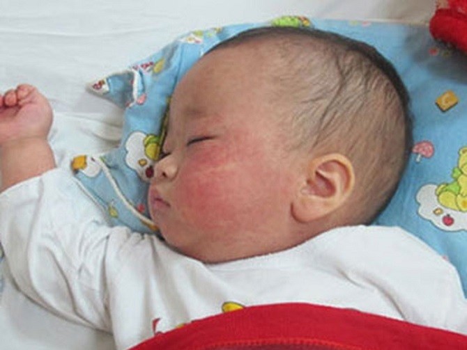 Tiêm chủng là biện pháp tốt nhất để phòng chống bệnh sởi